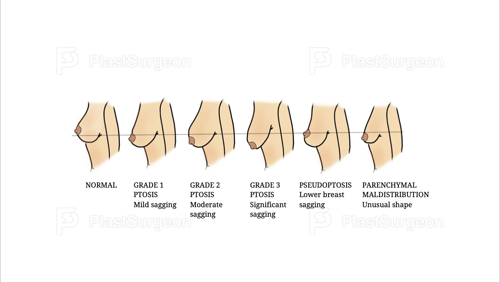 Different Types of Breast Shapes and Sizes