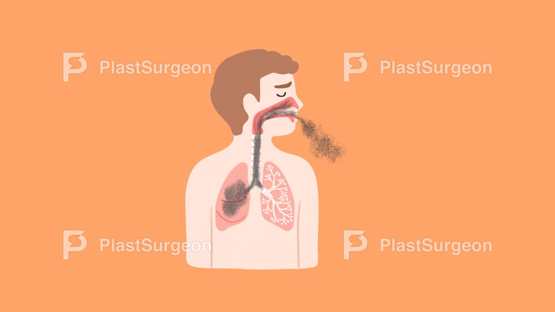 Burns – Inhalation Injury