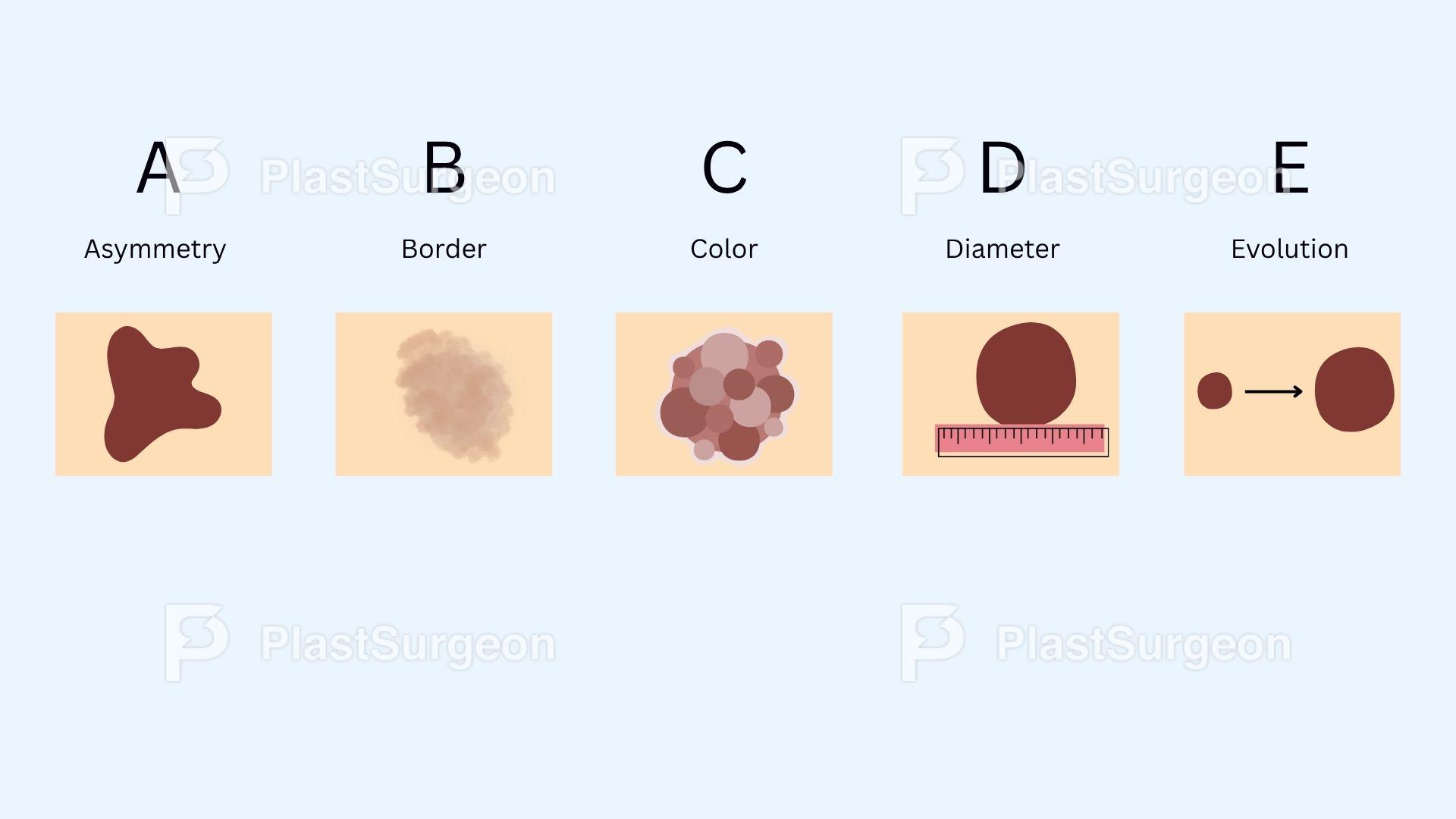 Melanoma – Clinical Features