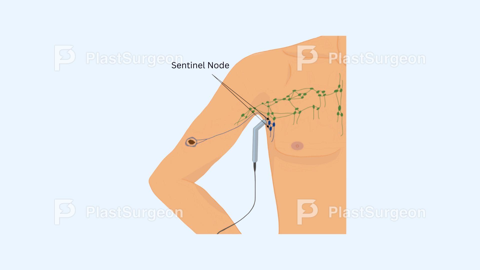 Melanoma – Management and Sentinel Node Biopsy