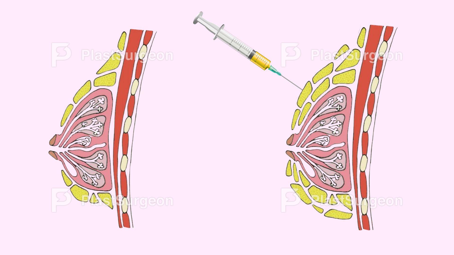 Breast – Breast Augmentation Using Autologue Fat