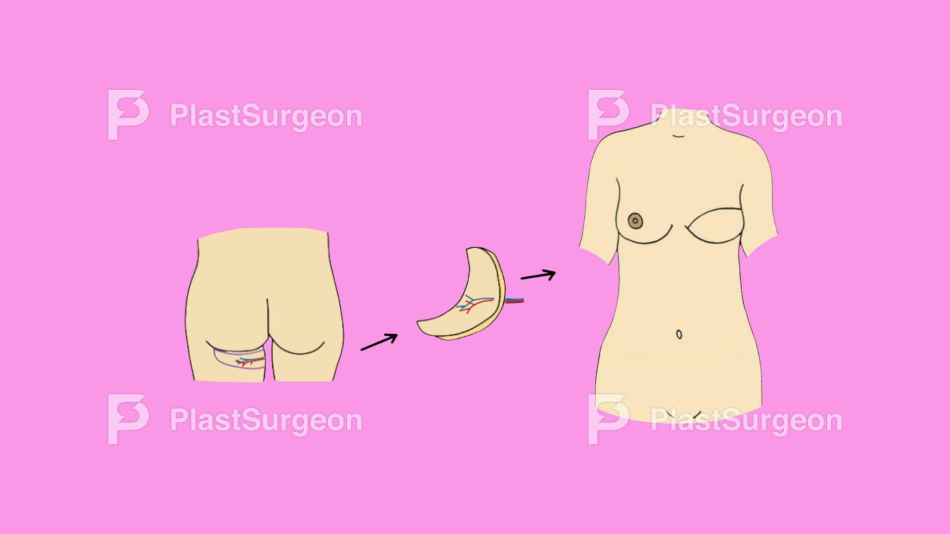 Breast Reconstruction – PAP Flap