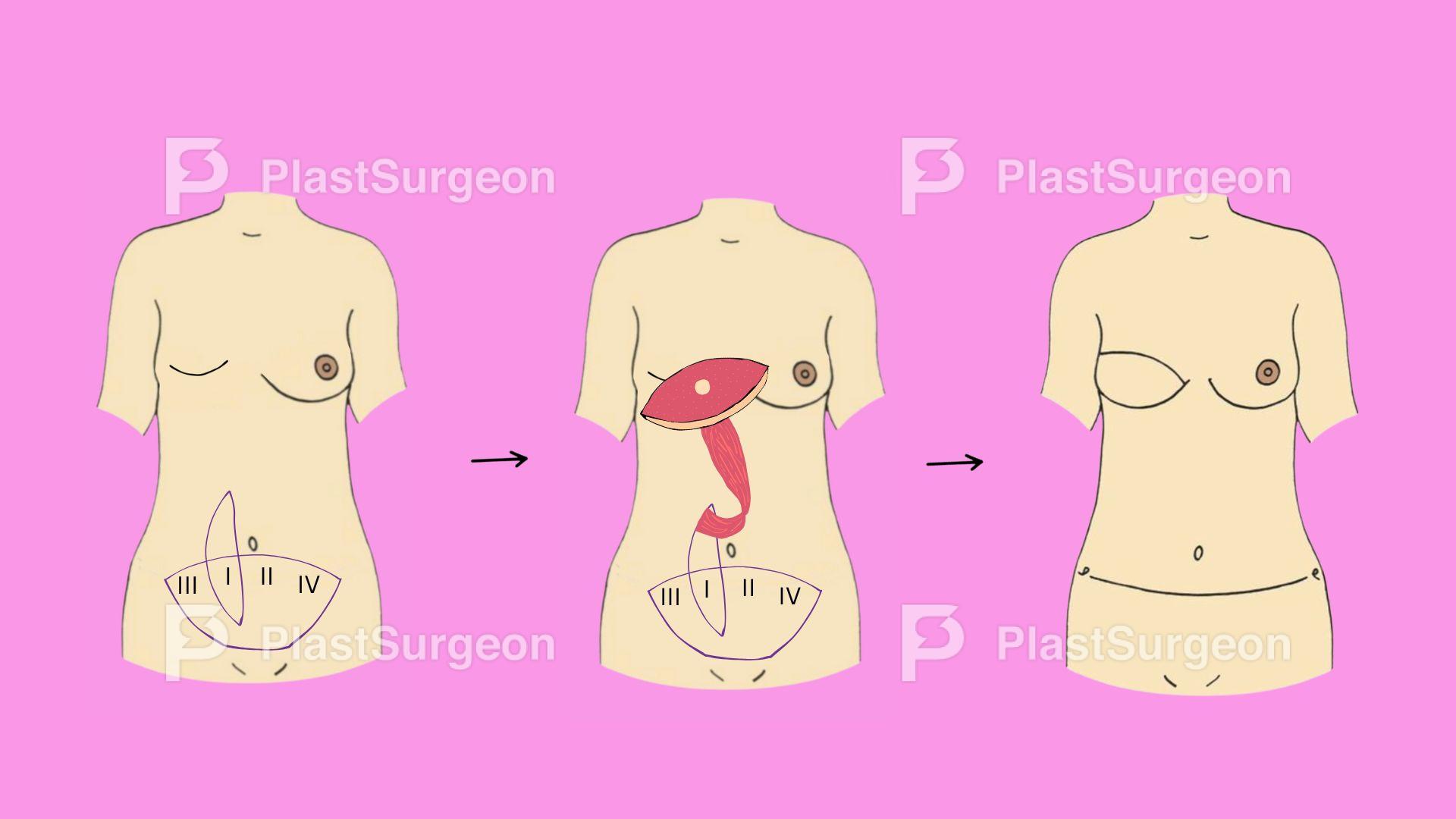 Breast Reconstruction – Pedicled TRAM Flap