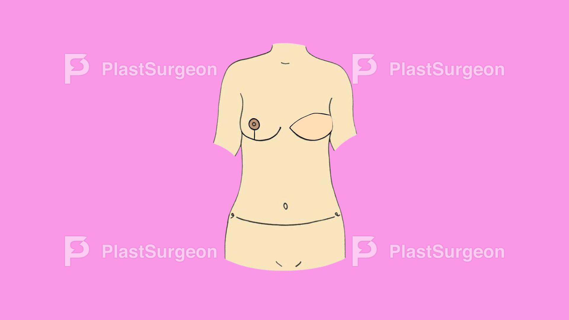 Breast Reconstruction – Secondary Procedures following Autologous Reconstruction