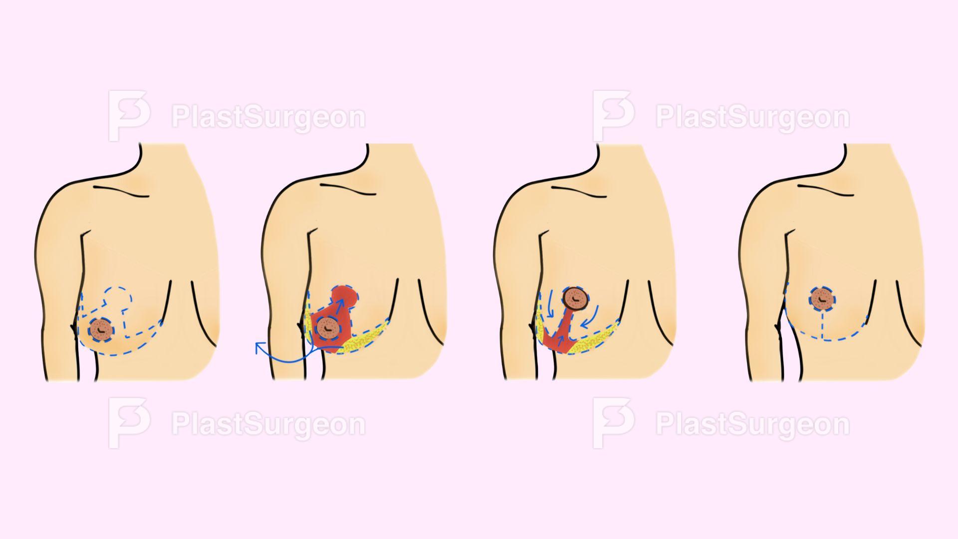 Breast – Reduction Mammaplasty