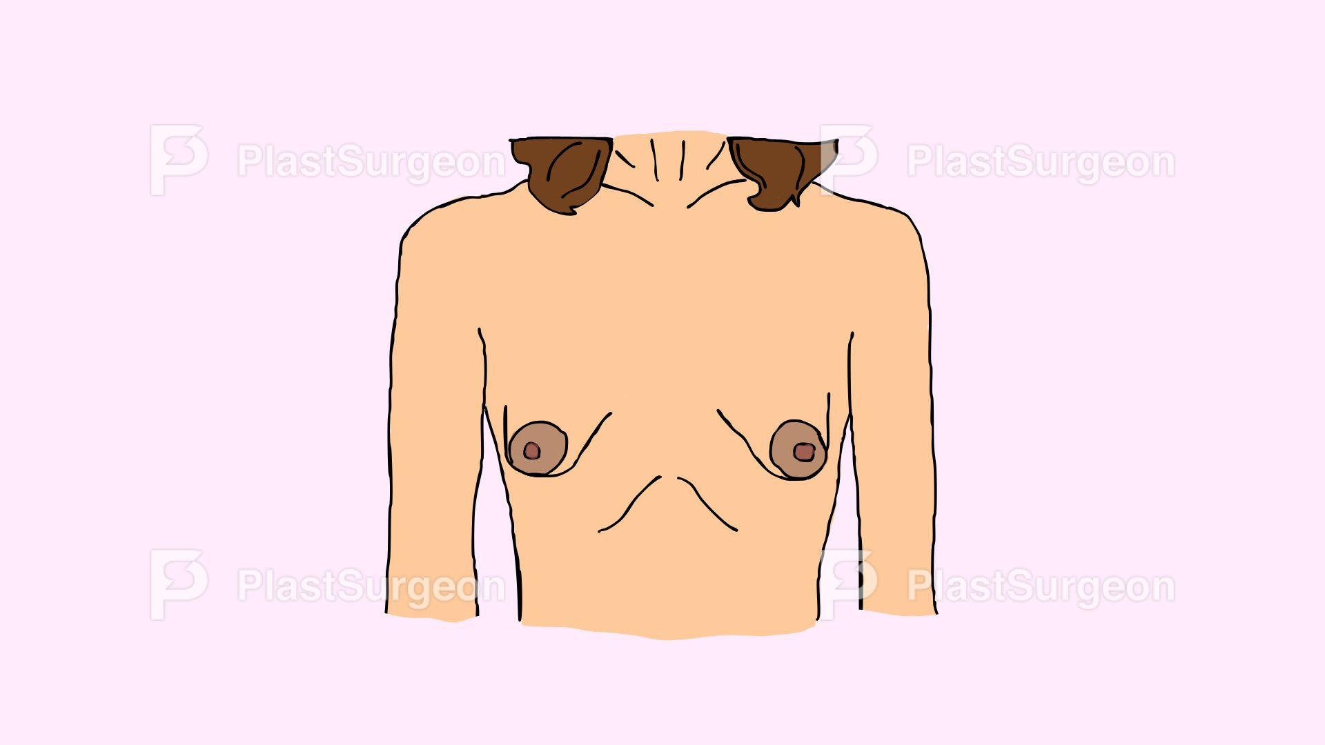 Breast – Tuberous Breast