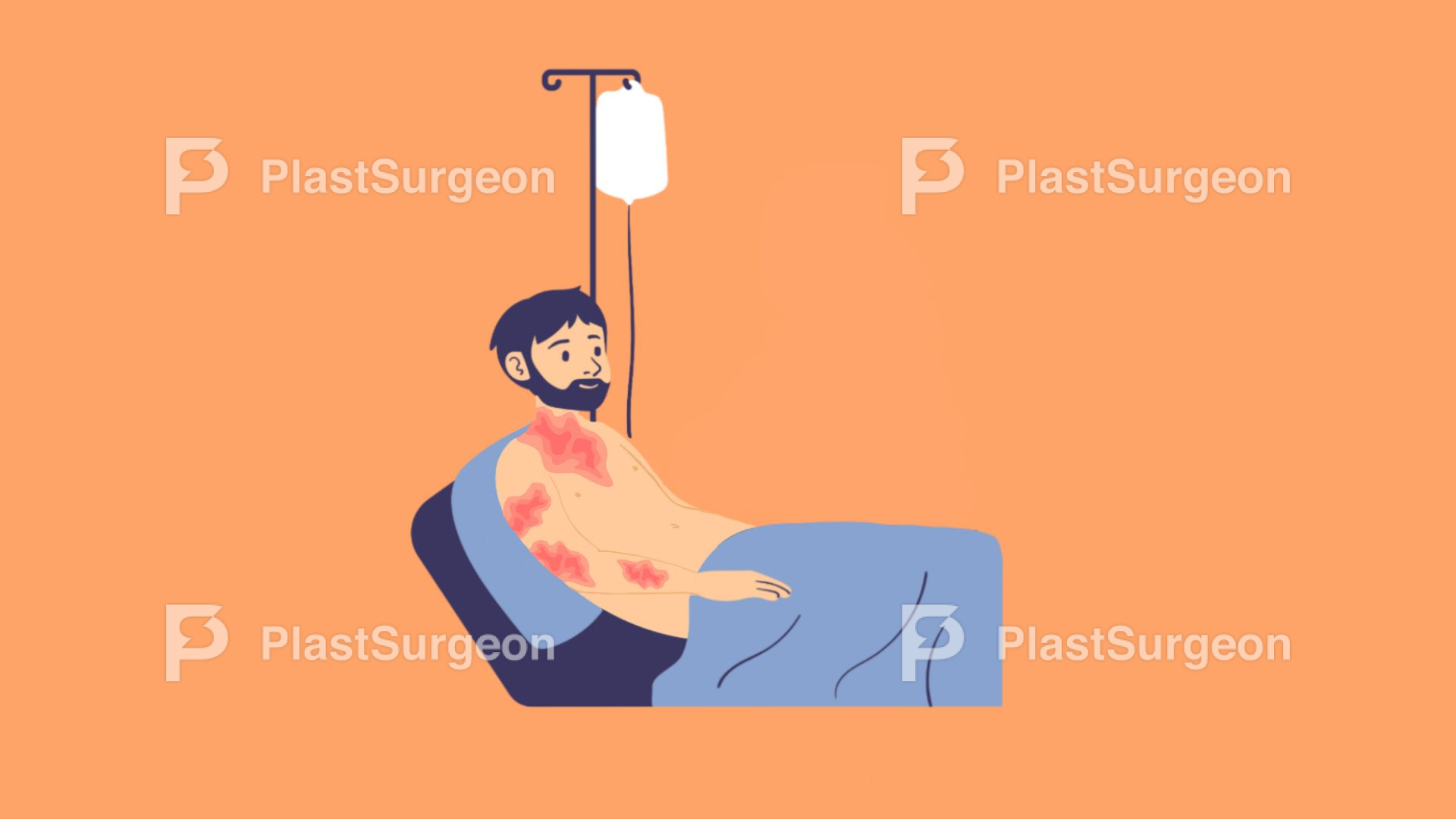 Burns – Fluid Resuscitation