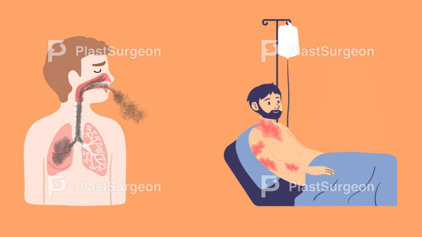 Burns – Inhalation Injury and Fluid Resuscitation