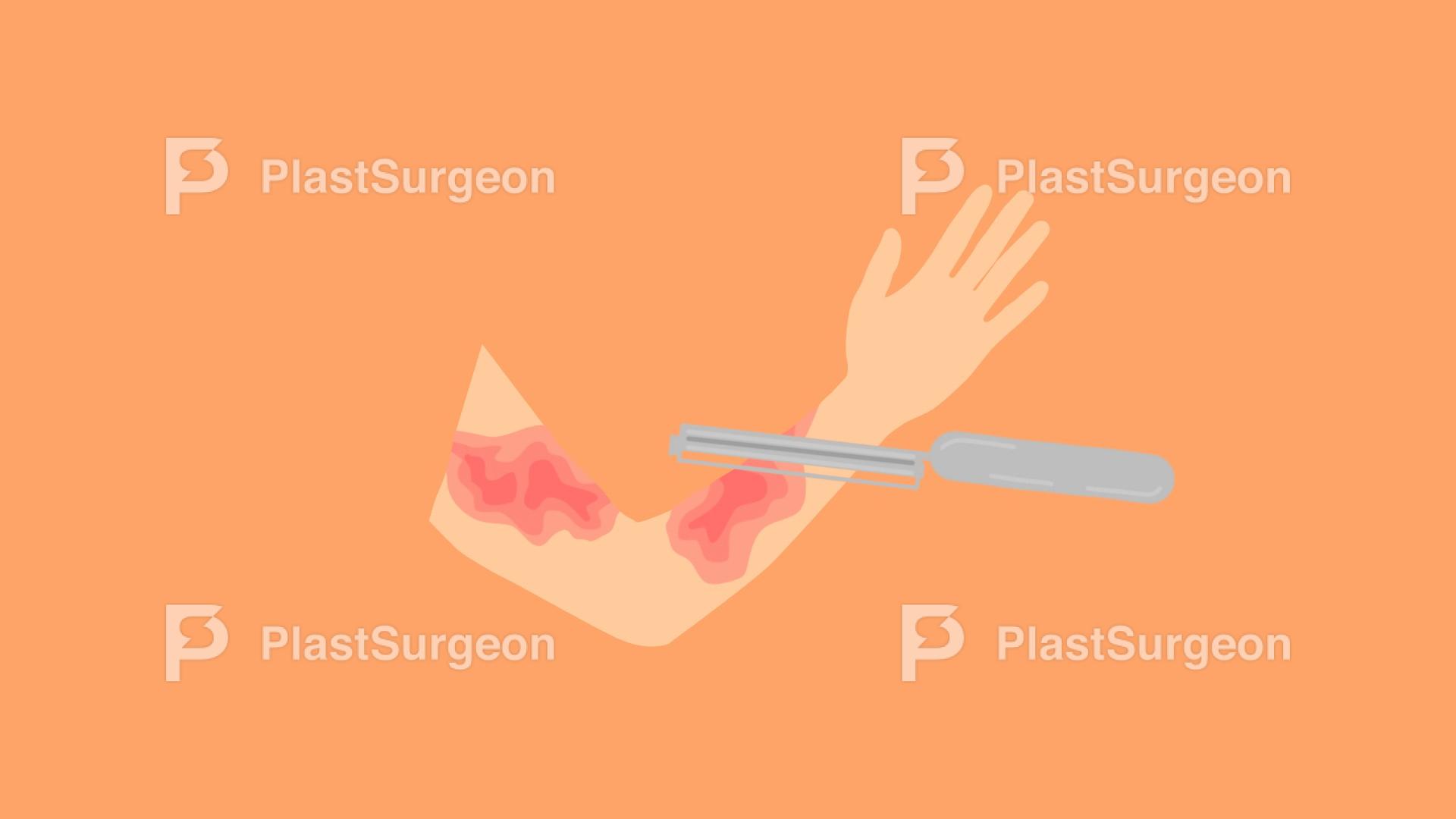 Burns – Surgical Management