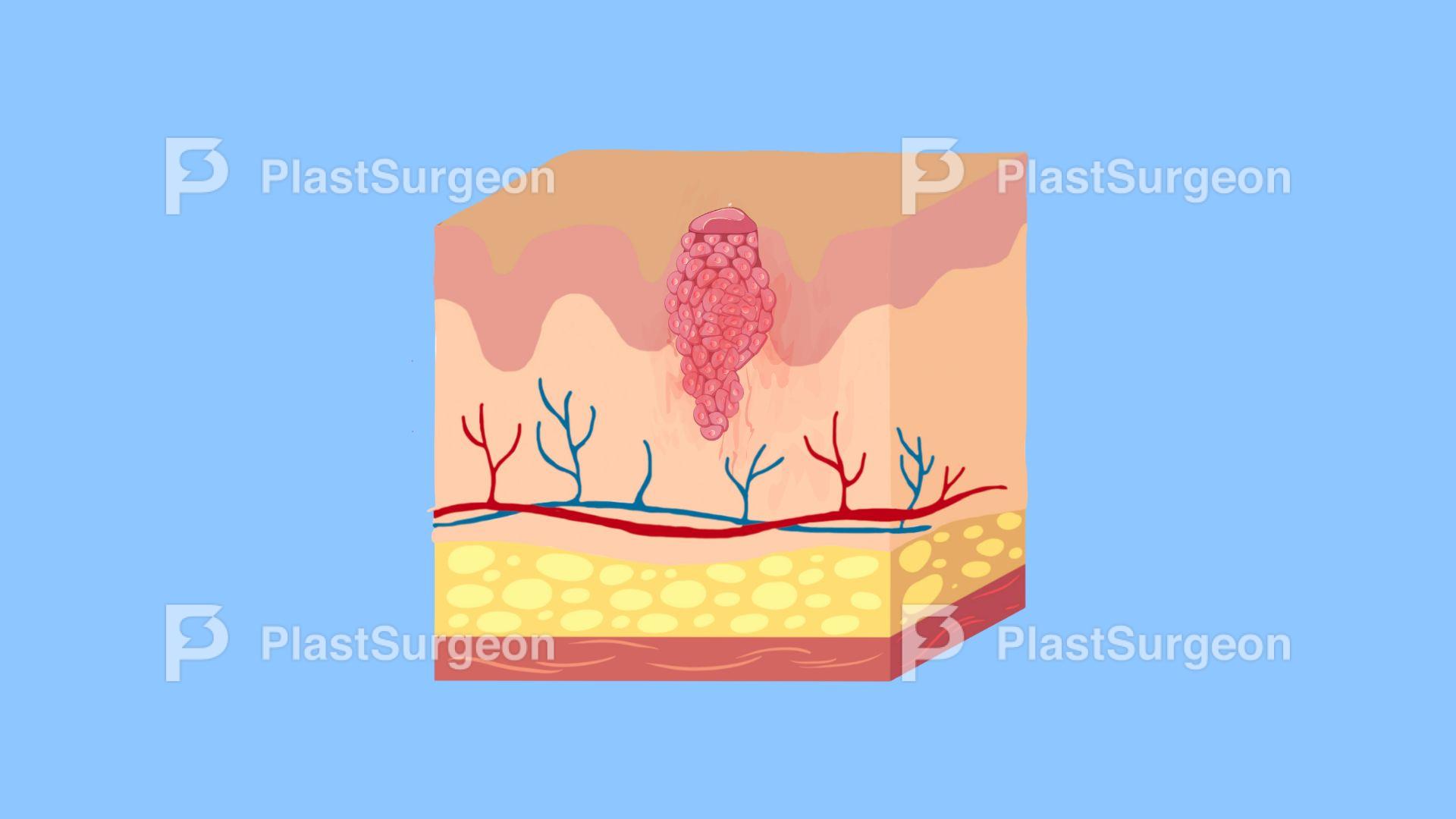 MCQ – non-melanoma skin cancer