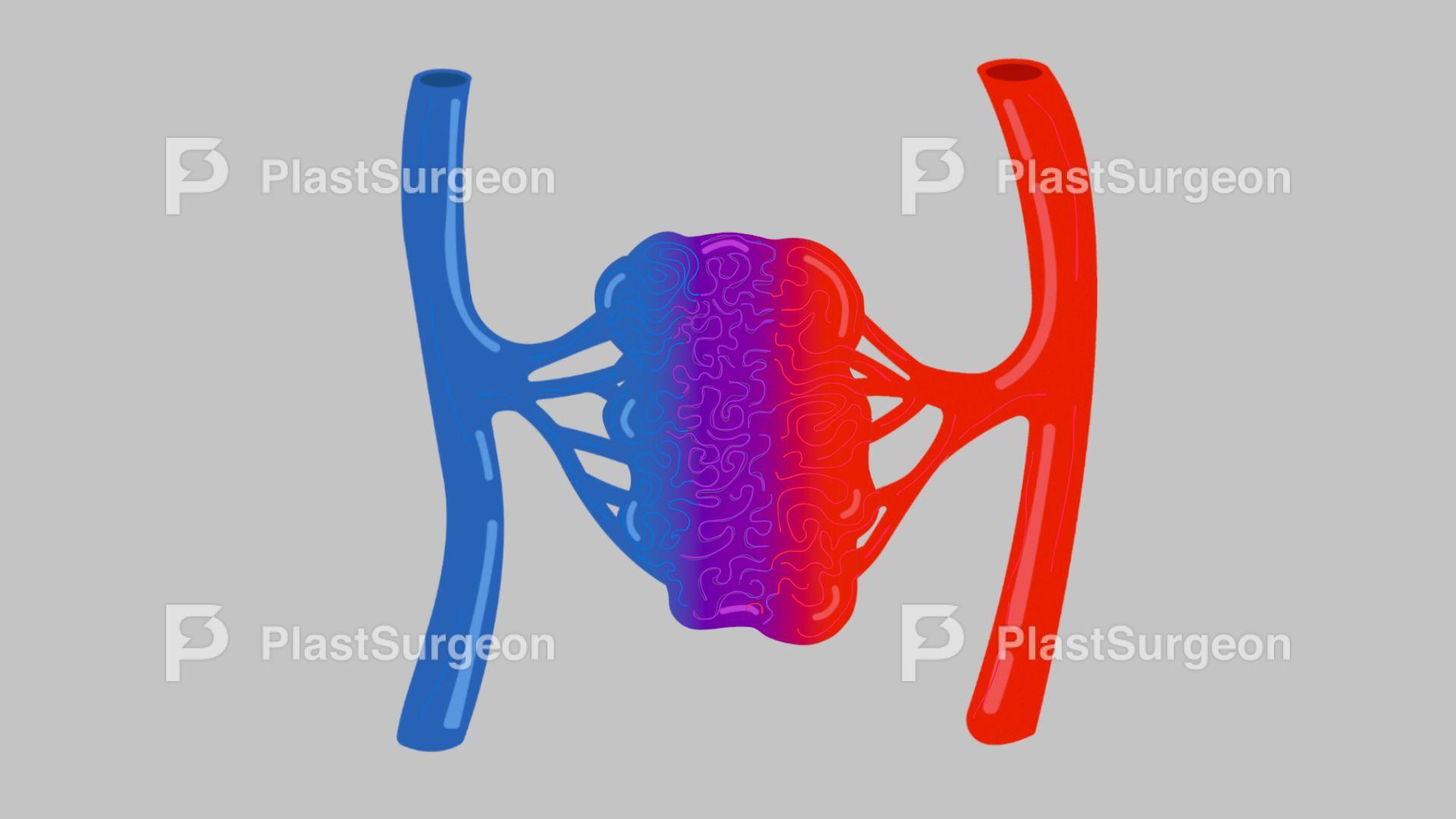 MCQ – vascular anomalies