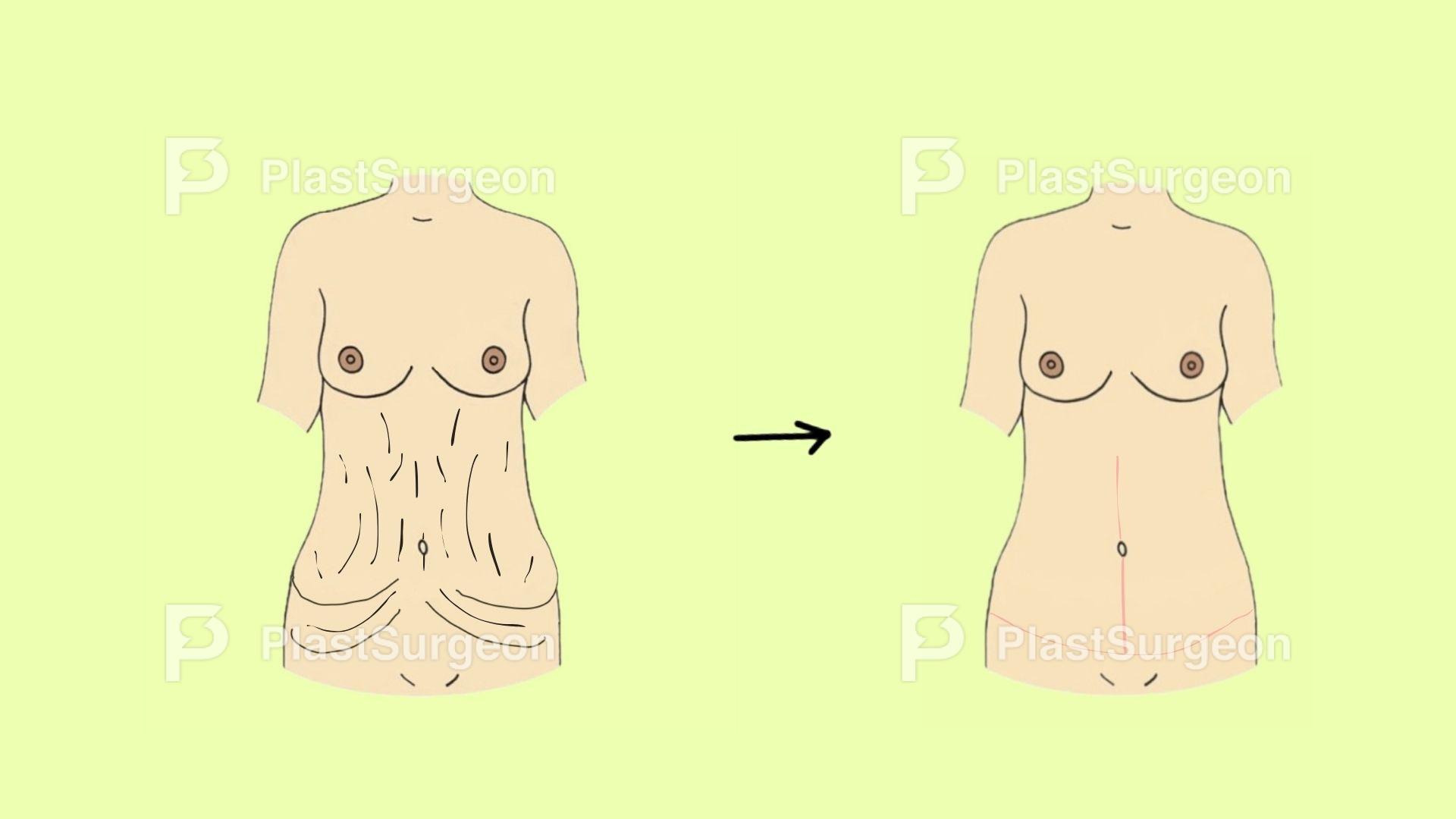 MCQ – massive weight loss